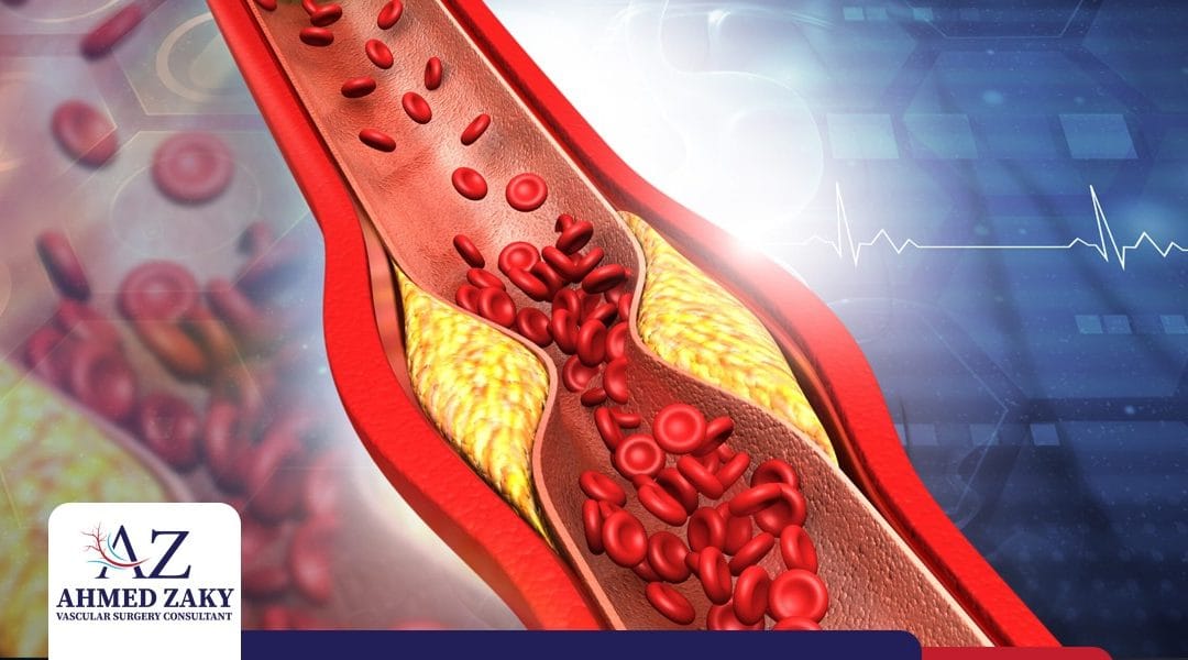 علاج انسداد شرايين الساق
