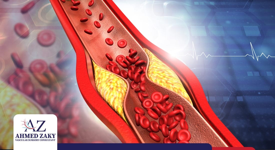 علاج-انسداد-شرايين-الساق علاج انسداد شرايين الساق