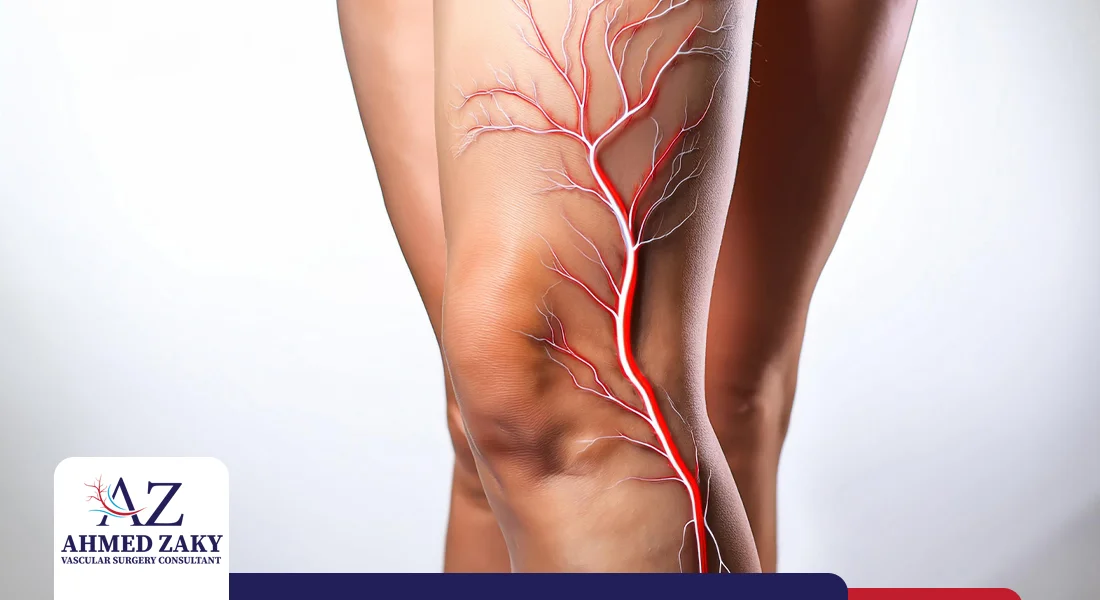 تغيير شرايين الساق تغيير شرايين الساق