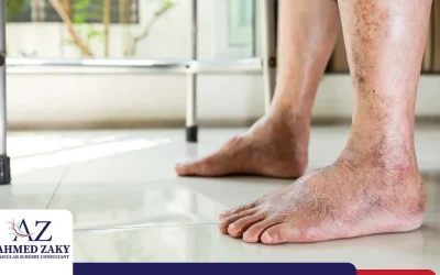 طرق علاج القدم السكري وخطورة اهمالها