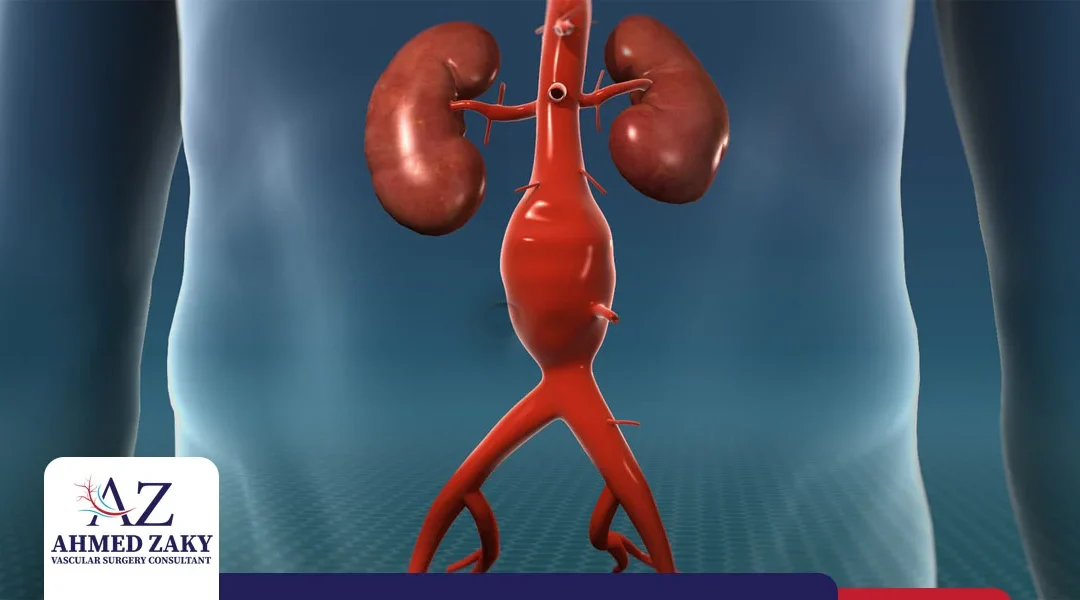 كيفية تشخيص و علاج تمدد الشريان الأورطي البطني