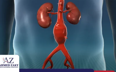 كيفية تشخيص و علاج تمدد الشريان الأورطي البطني