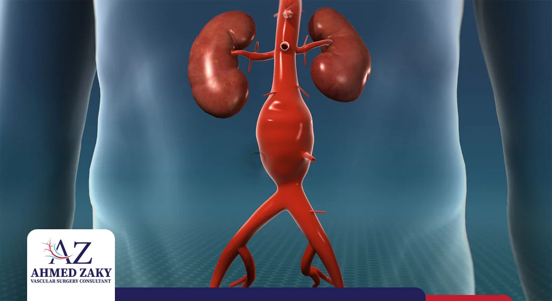 علاج تمدد الشريان الأورطي البطني علاج تمدد الشريان الأورطي البطني