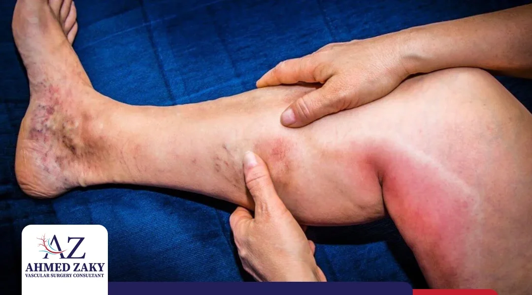 علاج جلطات الساق في الأوردة والشرايين
