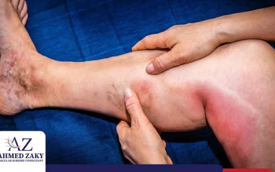 علاج جلطات الساق في الأوردة والشرايين