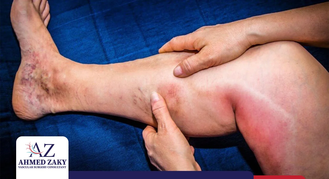 علاج جلطات الساق علاج جلطات الساق