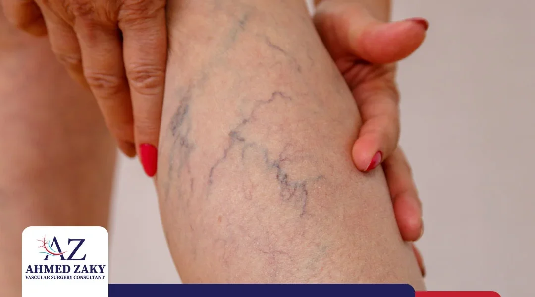 علاج دوالي الساقين ومن هم الأكثر عرضة للإصابة بها؟