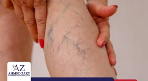 علاج دوالي الساقين