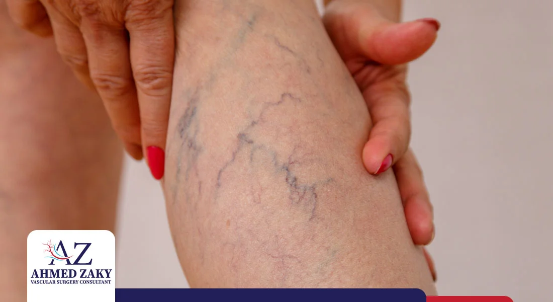 علاج-دوالي-الساقين علاج دوالي الساقين