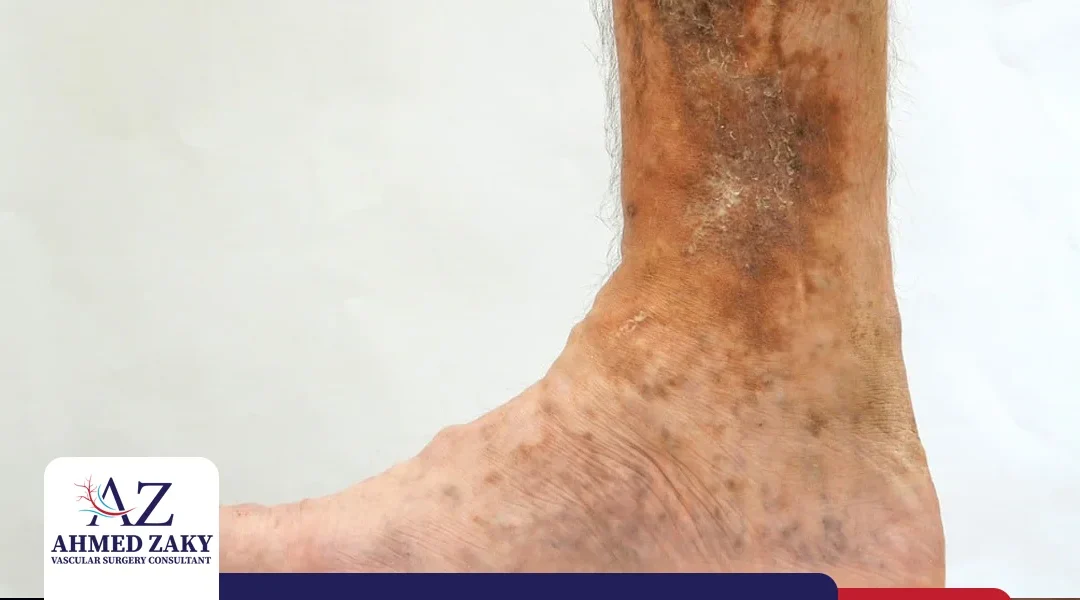 علاج قرحة الساق الوريدية