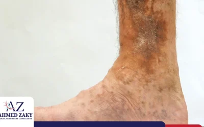 علاج قرحة الساق الوريدية