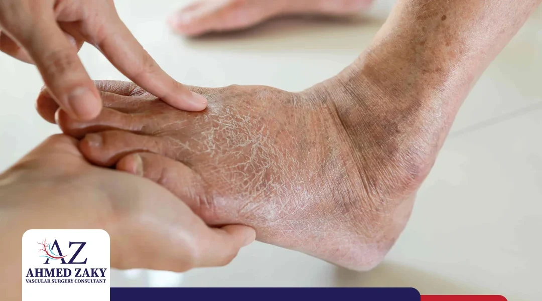 مراحل القدم السكري ونصائح هامة للمرضي