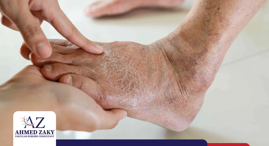 مراحل-القدم-السكري مراحل القدم السكري