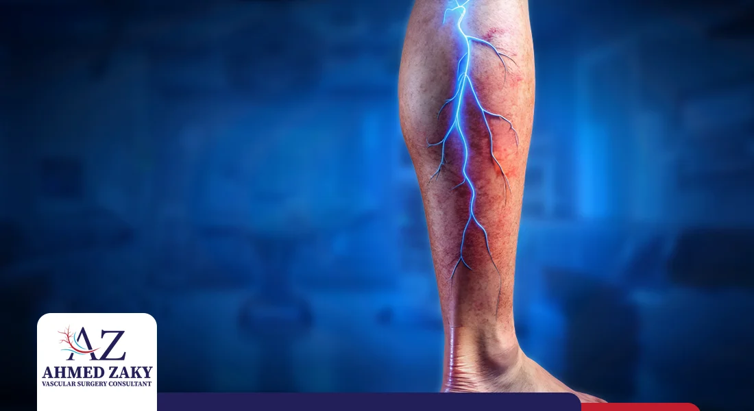 ألم بعد عملية دوالي الساقين