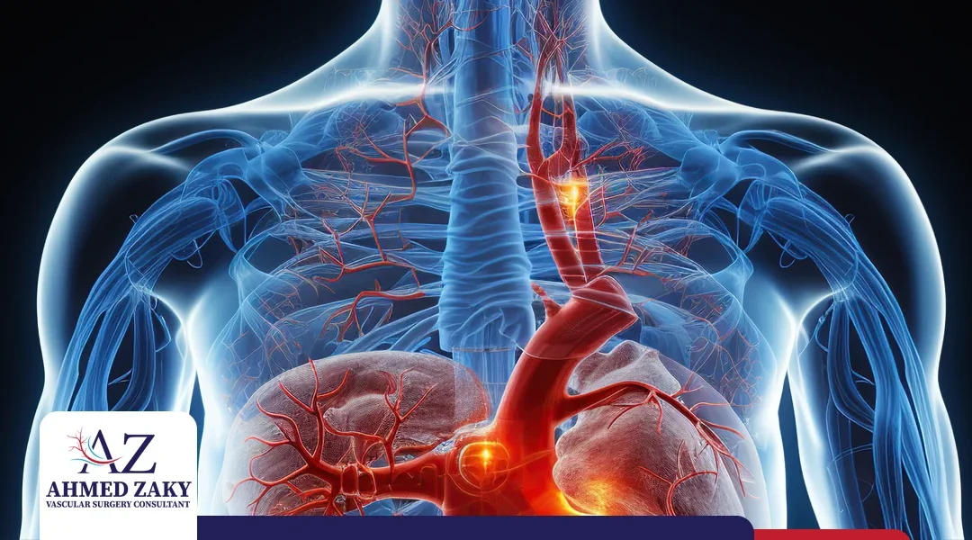 أعراض تمدد الشريان الأورطي الصدري والبطني