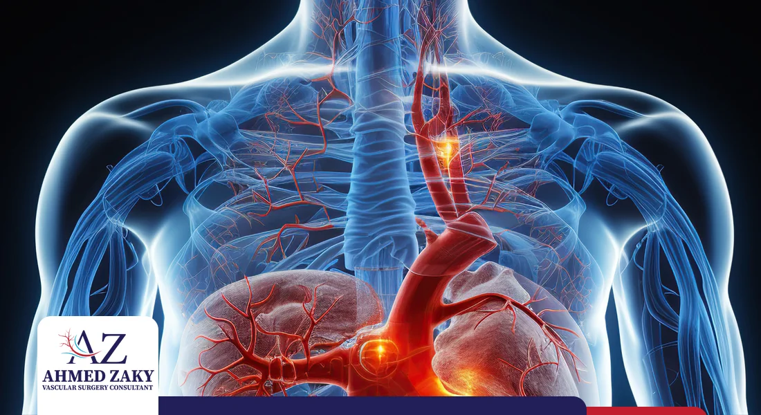 أعراض تمدد الشريان الأورطي الصدري