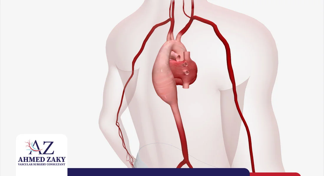 أعراض تمدد الشريان الأورطي