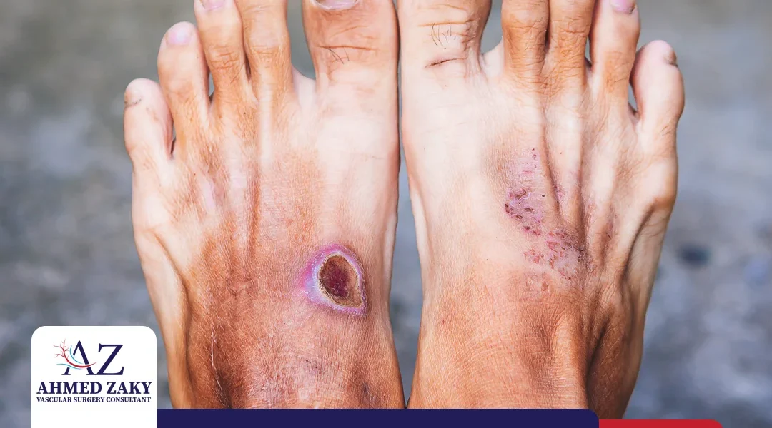 ما هي غرغرينا القدم السكرية؟ وأي أنواعها يهدد حياة المريض؟