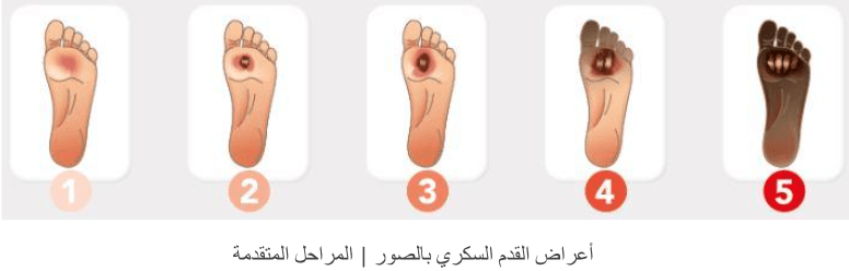 أعراض القدم السكري بالصور