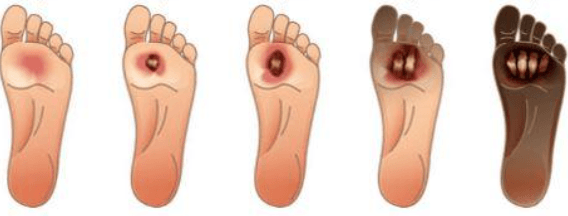 قرحة القدم السكري