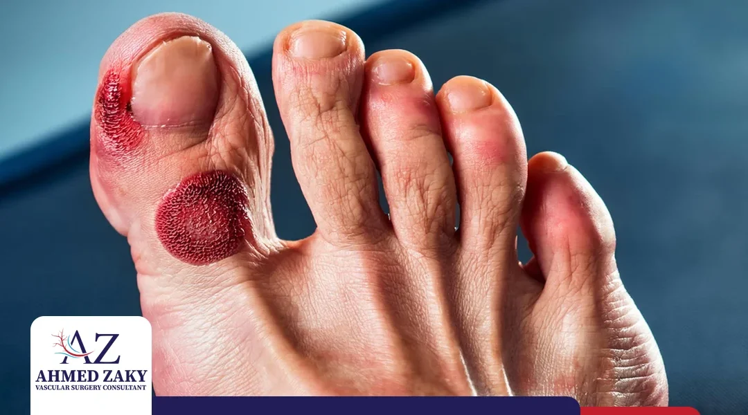 أعراض القدم السكري بالصور ونصائح للوقاية من هذه الأعراض