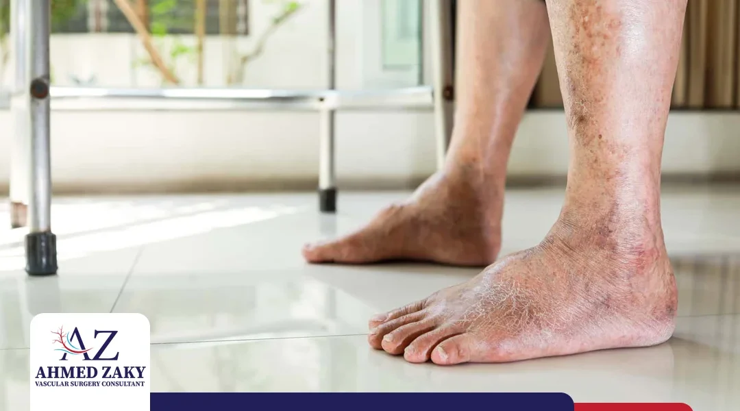 التهاب القدم السكري.. الأعراض وطرق العلاج