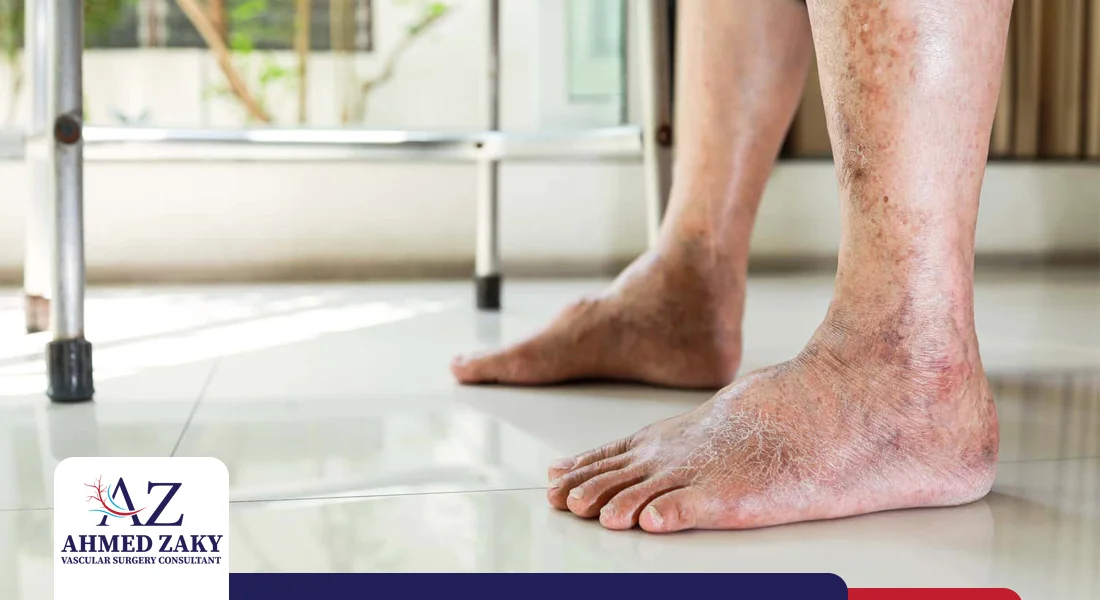 التهاب القدم السكري التهاب القدم السكري