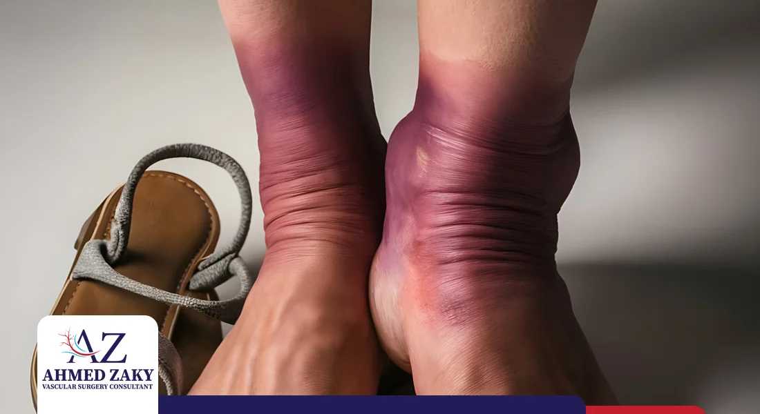 القدم-السكرية-المتورمة القدم السكري المتورمة