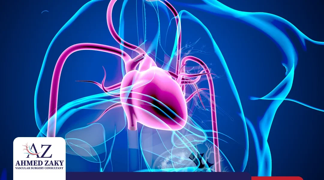 تصلب الشريان الأورطي