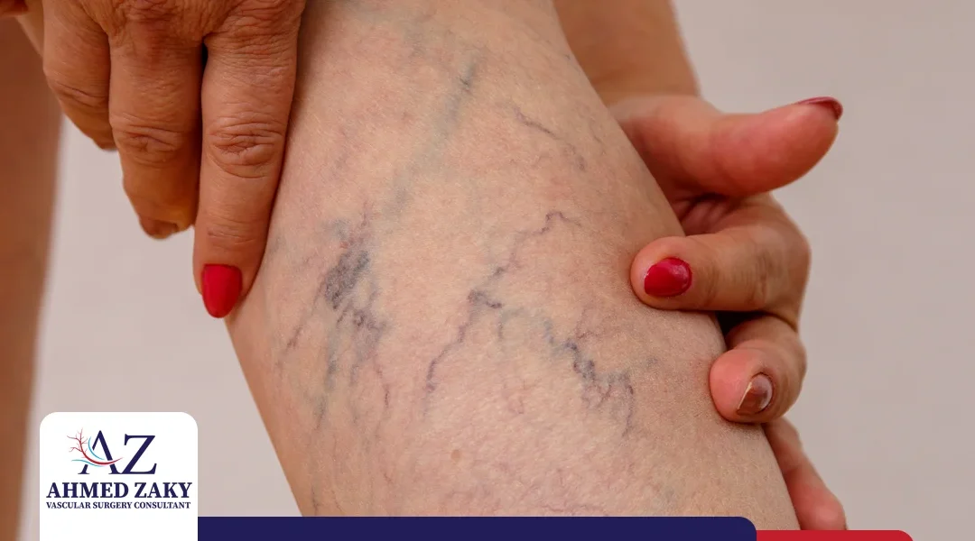 دوالي الساقين للنساء | لم هن أكثر عرضة للإصابة؟