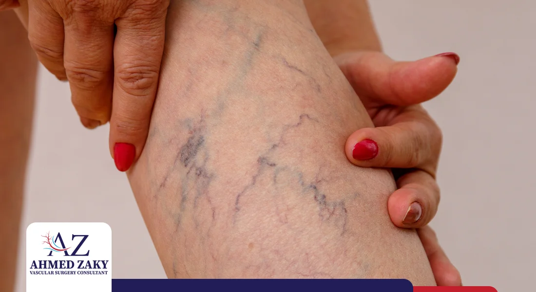 دوالي الساقين للنساء دوالي الساقين للنساء