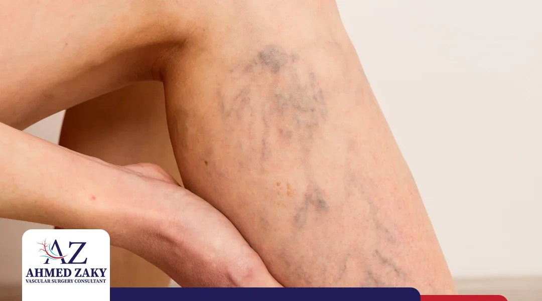 شكل دوالي الساقين ودوره في تحديد خطة العلاج