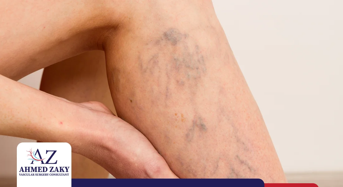 شكل-دوالي-الساقين شكل دوالي الساقين