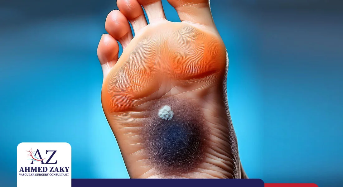 قرحة القدم السكري