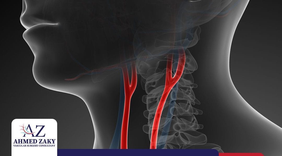 الضغط على الشريان السباتي وانسداده.. الأسباب والأعراض وطرق العلاج