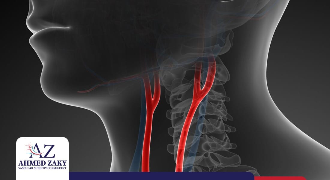 الضغط على الشريان السباتي الضغط على الشريان السباتي