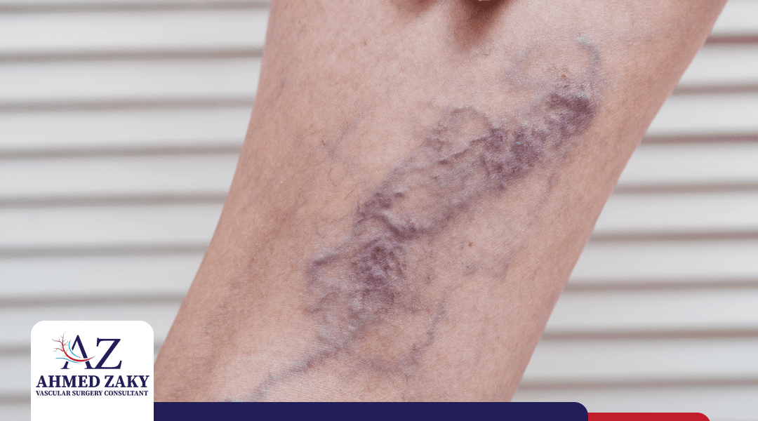 انتفاخ دوالي الساقين: الأسباب والعلاج وطرق الوقاية