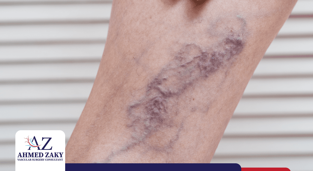 انتفاخ دوالي الساقين