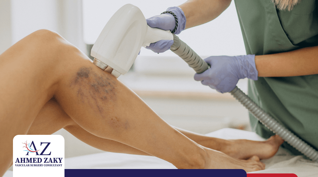 معايير تحديد تكلفة عملية دوالي الساقين بالليزر