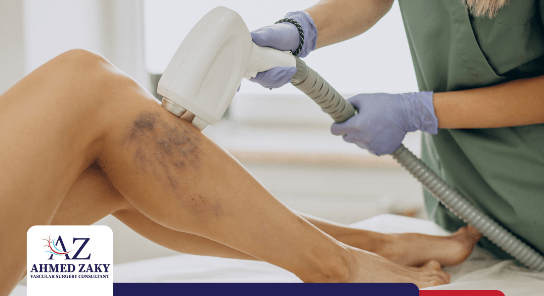 تكلفة عملية دوالي الساقين