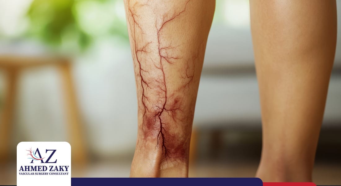 جلطة شرايين الساق جلطة شرايين الساق