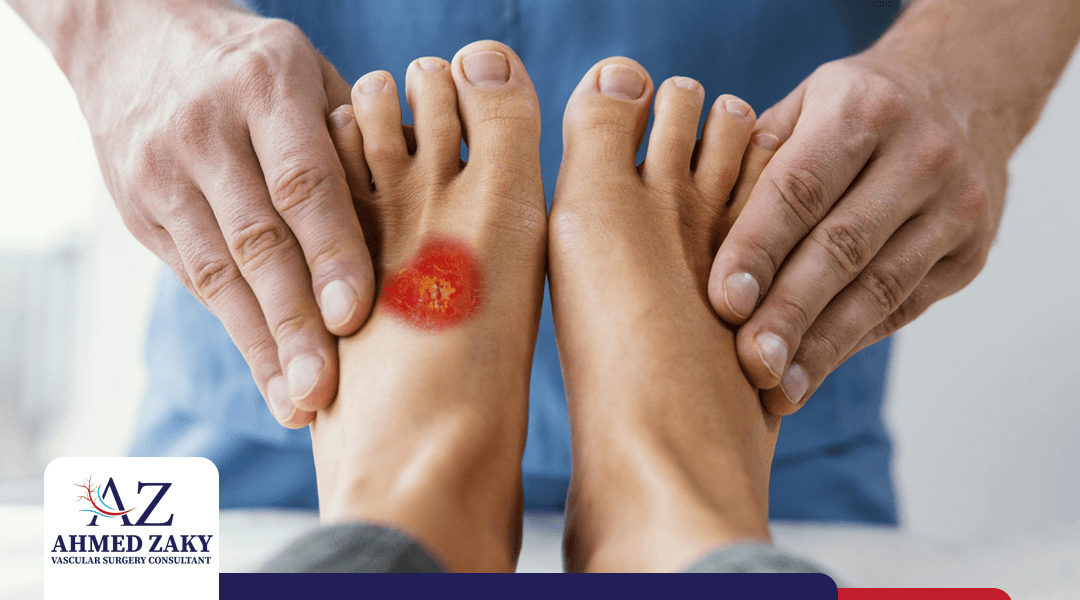 فطريات القدم السكري.. أسبابها وأعراضها وطرق التعامل معها