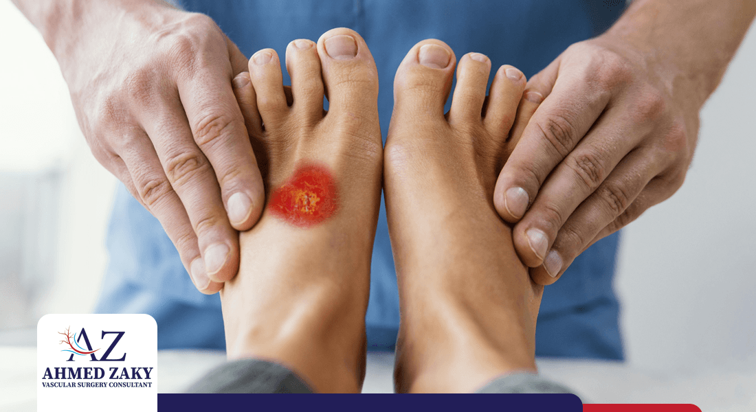 فطريات القدم السكري