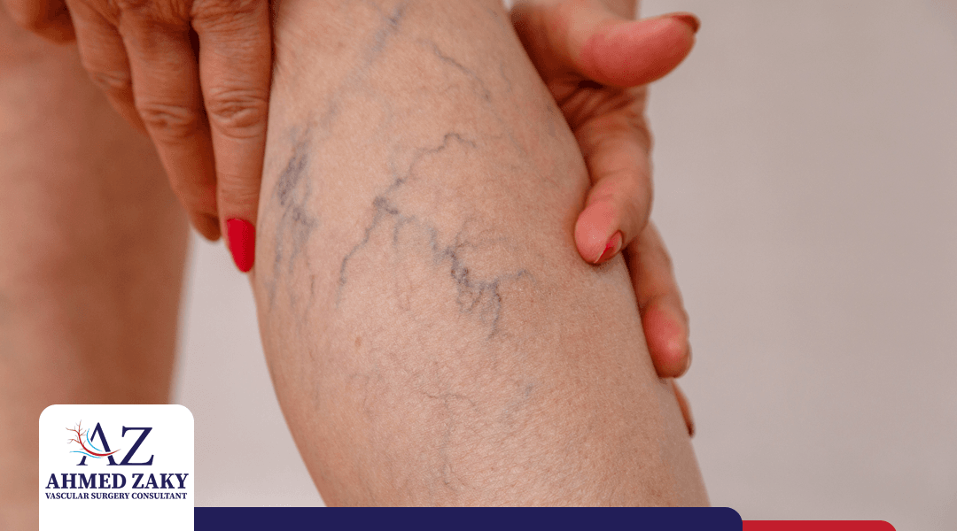 اضرار الدوالي الساقين.. 5 تأثيرات يجب الانتباه لها