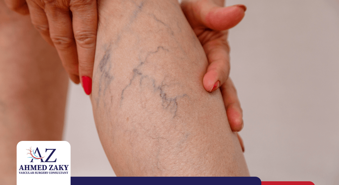 اضرار-الدوالي-الساقين اضرار الدوالي الساقين