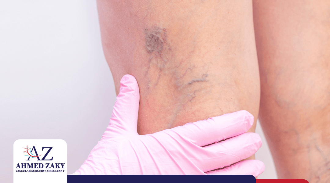 اعراض دوالي الساقين.. كيف تتأكد من إصابتك بهذه المشكلة؟