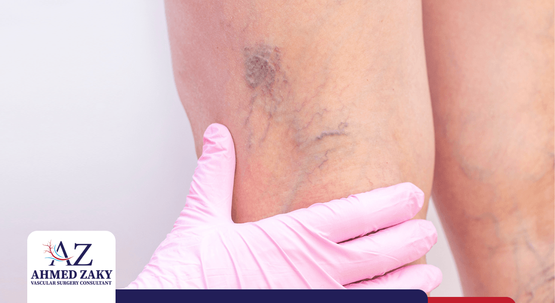 اعراض-دوالي-الساقين اعراض دوالي الساقين