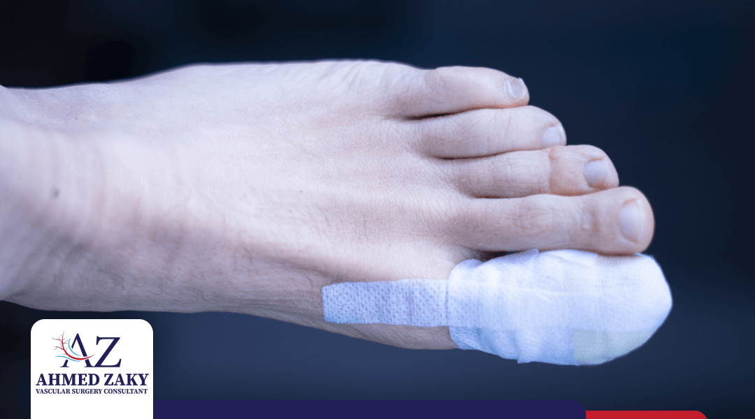 عملية بتر القدم السكري