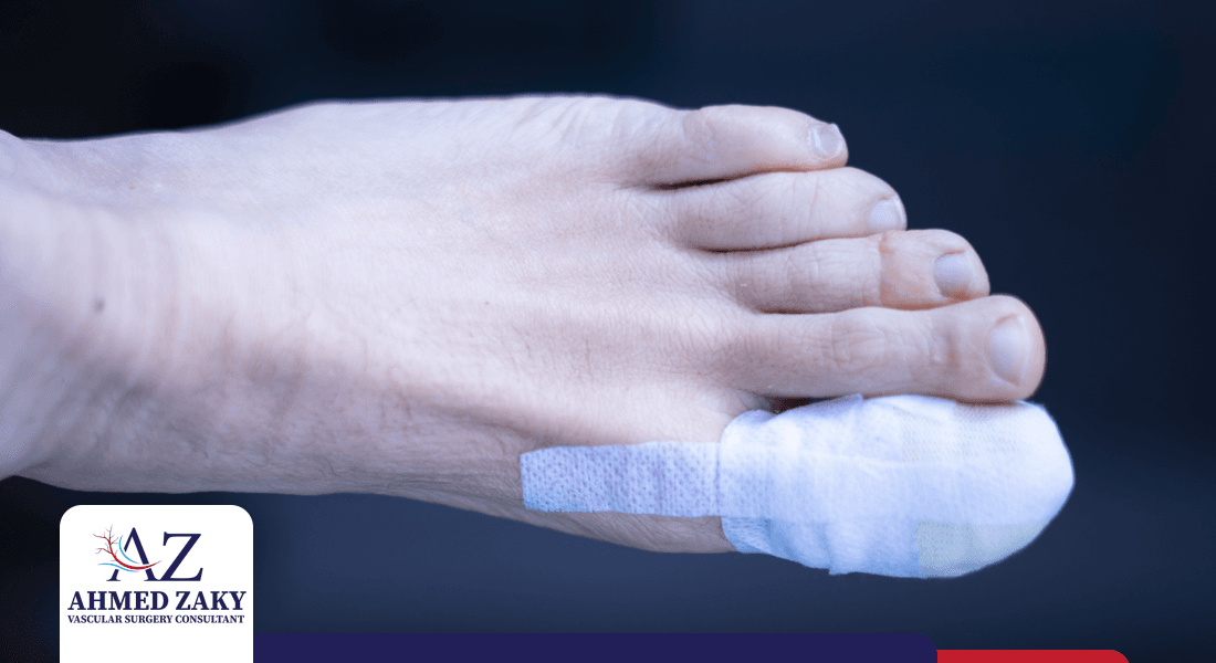 بتر القدم السكري عملية بتر القدم السكري