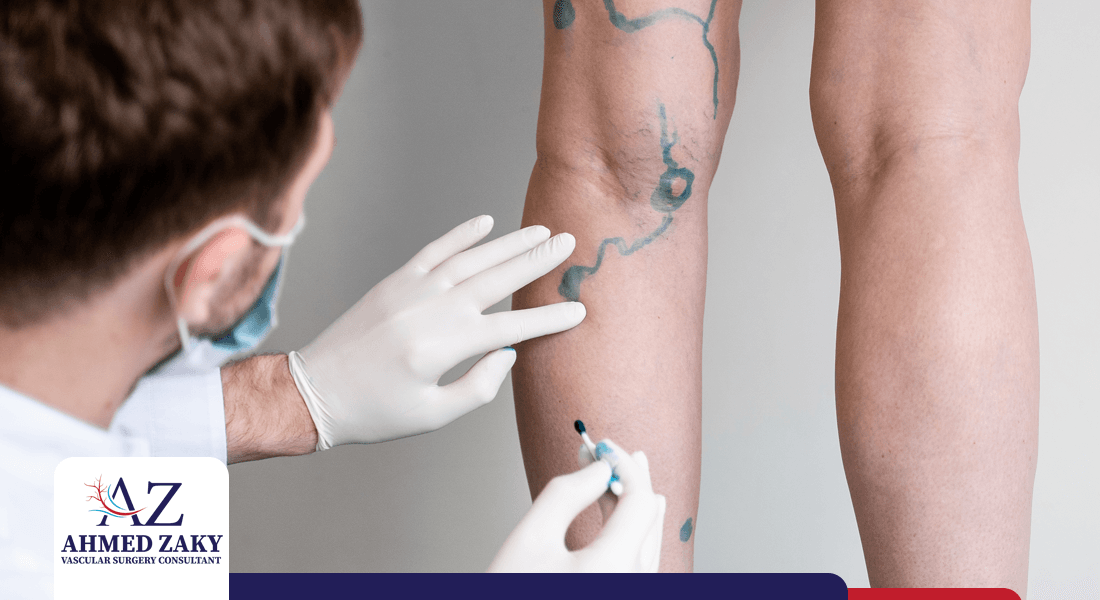 تجربتي-مع-حقن-الدوالي تجربتي مع حقن الدوالي